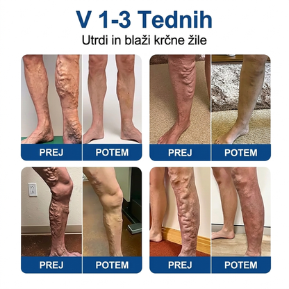 ✅ ✅✅Medistart® Visszérápoló Mikrotűs Gondozó Tapasz ⚡ Azonnali Megkönnyebbülés, Hosszú Távú Eredmények