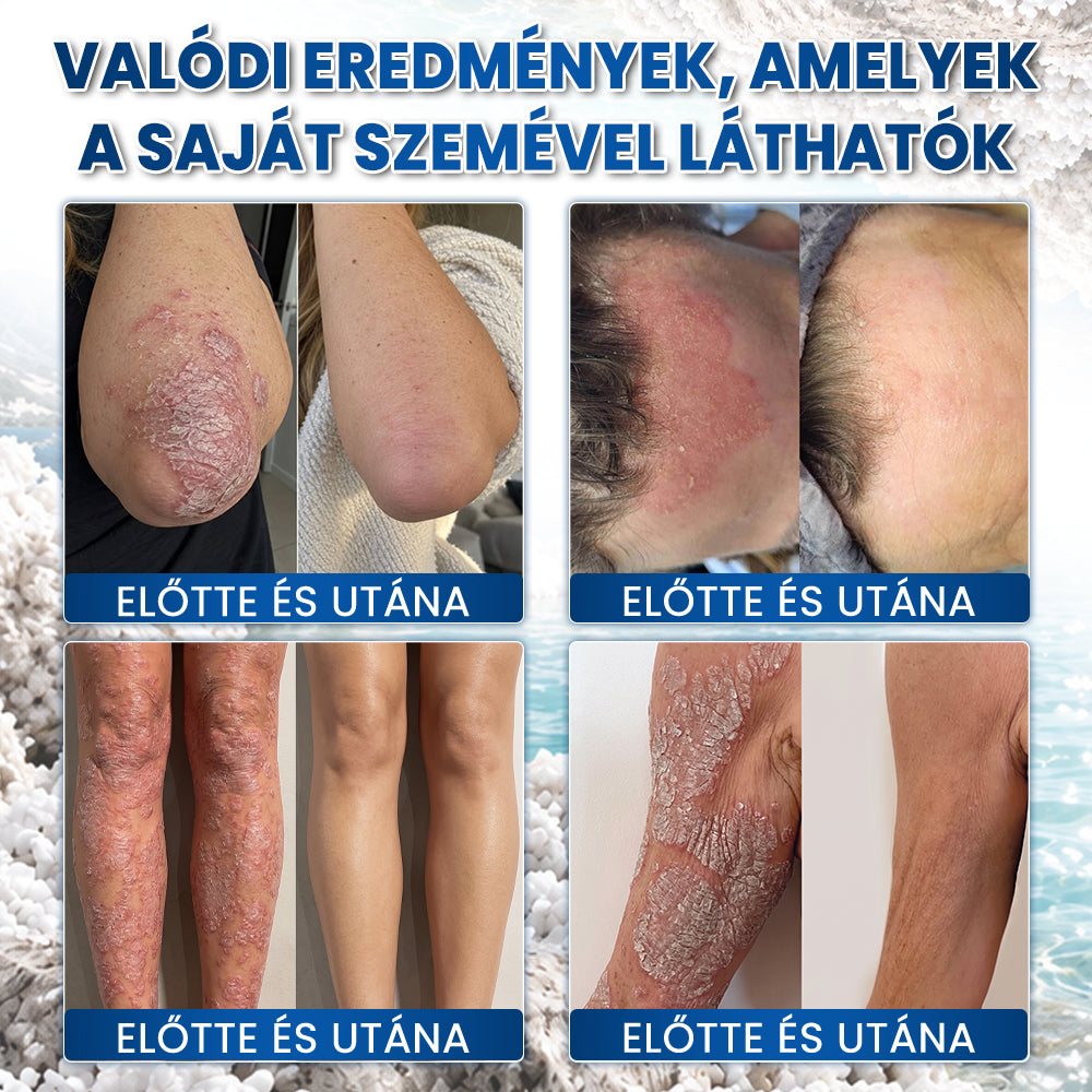 👩‍⚕️✅Medistart® PSZORIÁZIS SPECIÁLIS BŐRÁPOLÓ