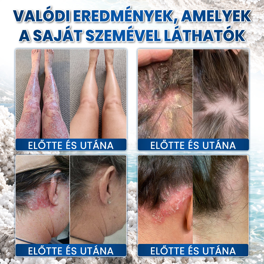 👩‍⚕️✅Medistart® PSZORIÁZIS SPECIÁLIS BŐRÁPOLÓ