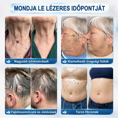 PuraCure® 👩‍⚕️ 𝟕 𝐍𝐚𝐩𝐨𝐬 Bőrkinövés- és Folteltávolító Toll Fájdalommentes és Hegmentes Professzionális Rollerball