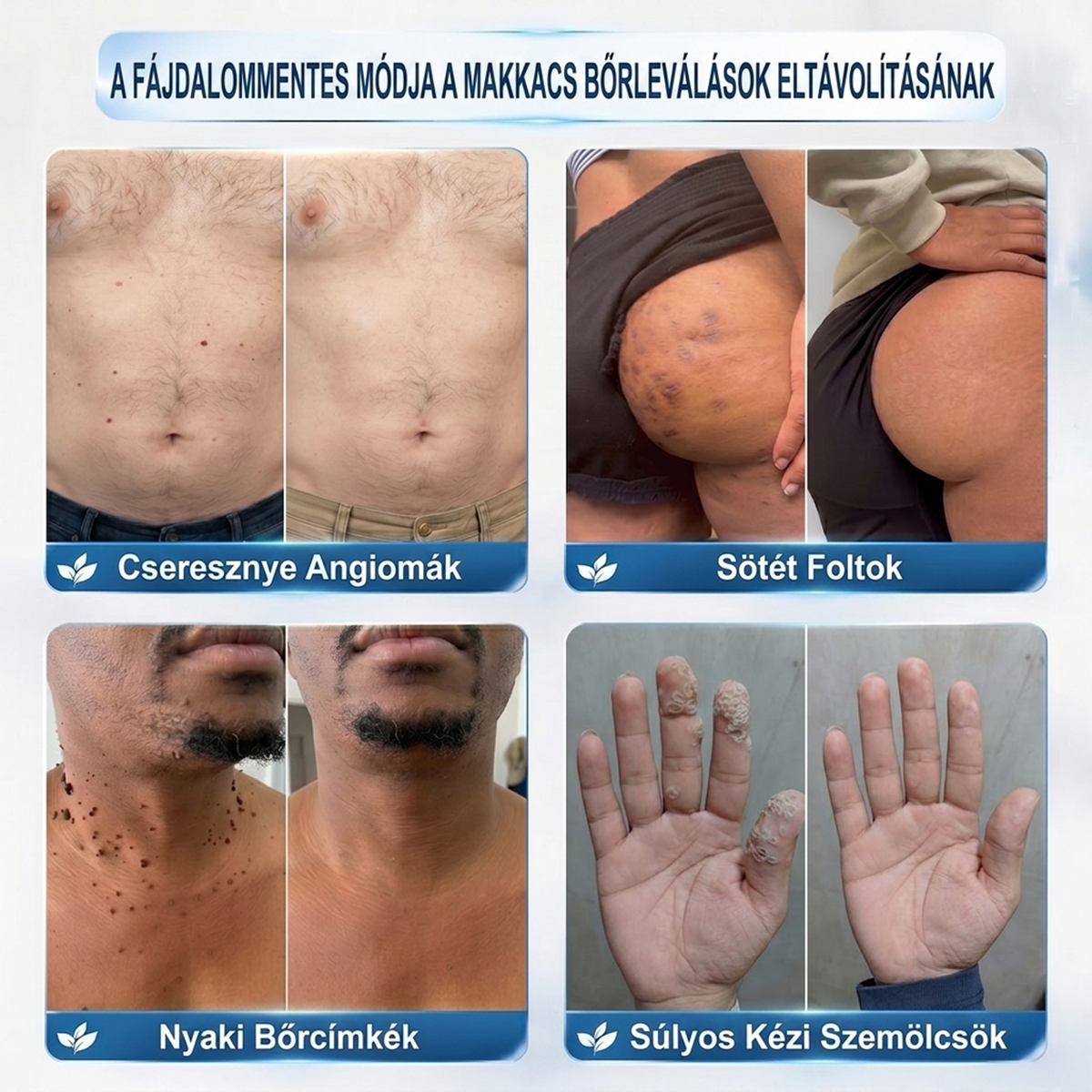 PuraCure® 👩‍⚕️ 𝟕 𝐍𝐚𝐩𝐨𝐬 Bőrkinövés- és Folteltávolító Toll Fájdalommentes és Hegmentes Professzionális Rollerball