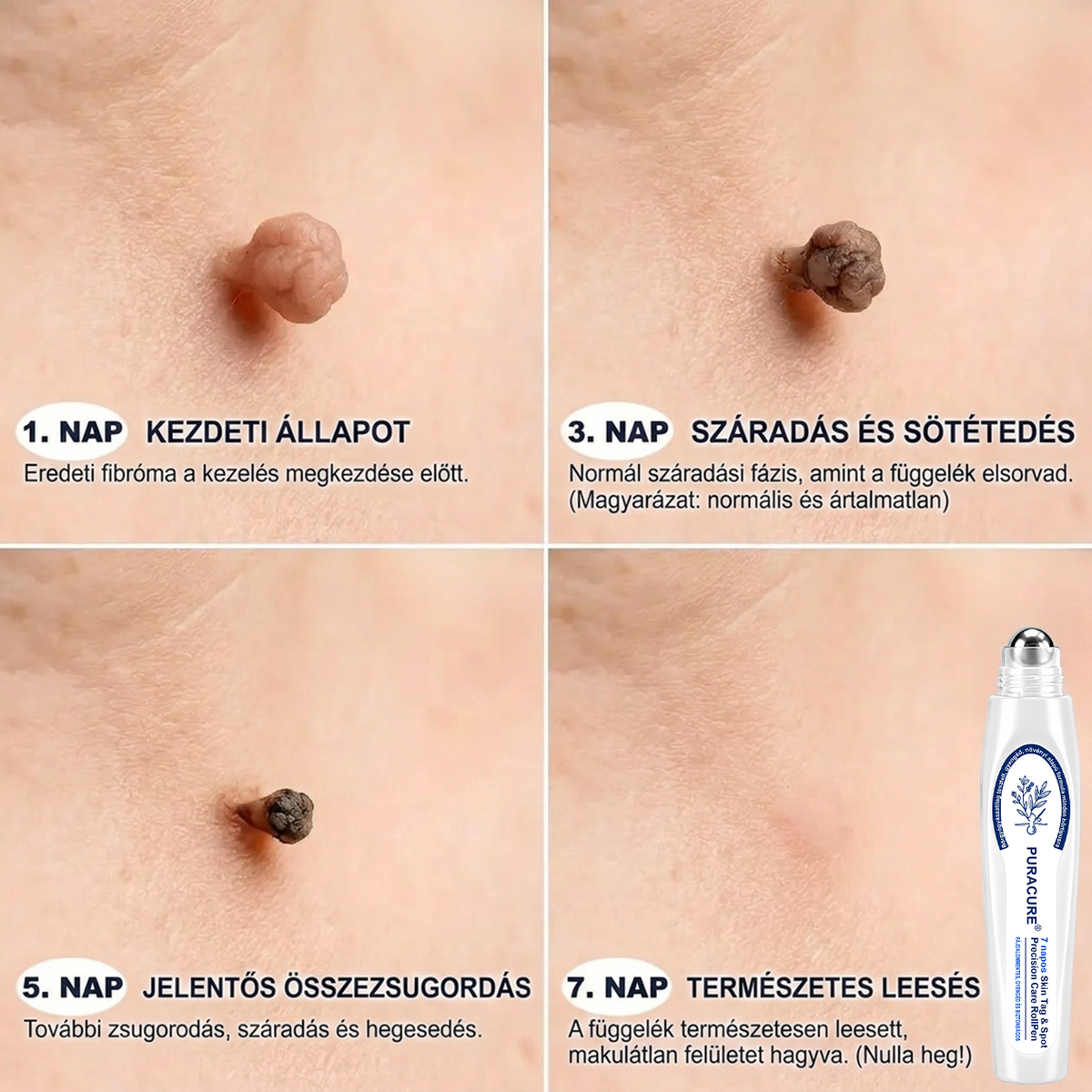PuraCure® 👩‍⚕️ 𝟕 𝐍𝐚𝐩𝐨𝐬 Bőrkinövés- és Folteltávolító Toll Fájdalommentes és Hegmentes Professzionális Rollerball