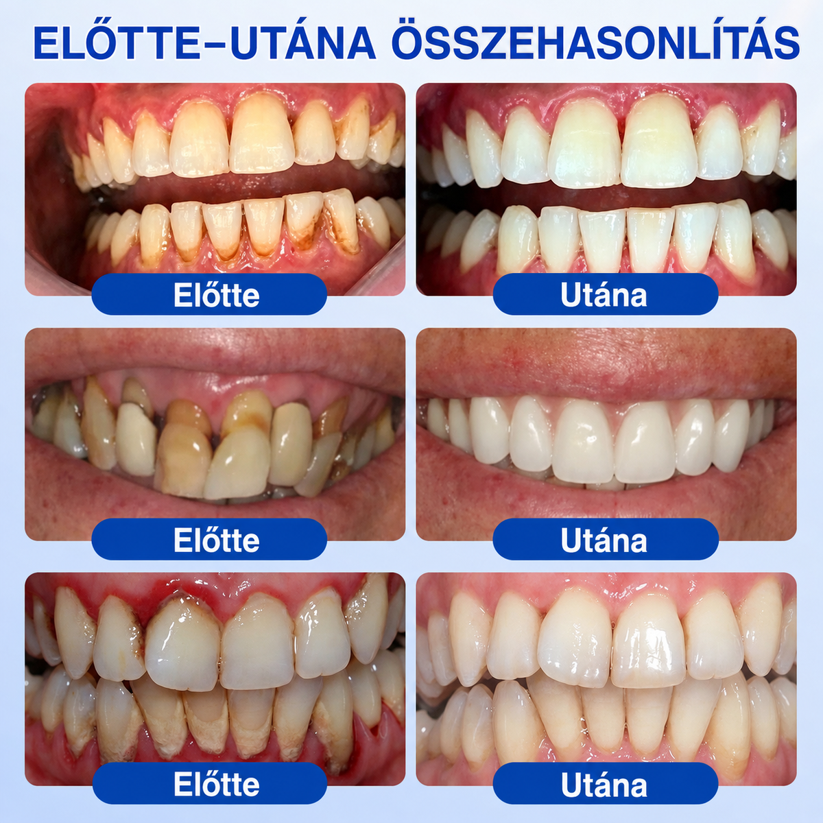 🇭🇺👨‍⚕️👨‍⚕️👨‍⚕️✅🦷 PuraCure® ÍNYMEGÚJÍTÓ – Parodontális helyreállító gél🧂
