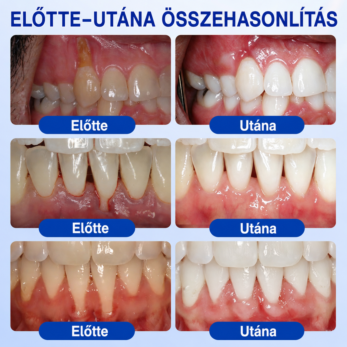 🇭🇺👨‍⚕️👨‍⚕️👨‍⚕️✅🦷 PuraCure® ÍNYMEGÚJÍTÓ – Parodontális helyreállító gél🧂