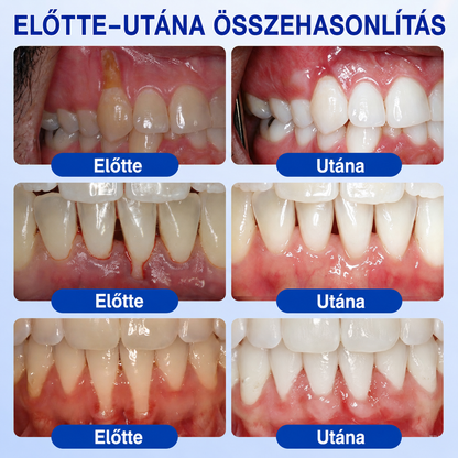 🇭🇺👨‍⚕️👨‍⚕️👨‍⚕️✅🦷 PuraCure® ÍNYMEGÚJÍTÓ – Parodontális helyreállító gél🧂